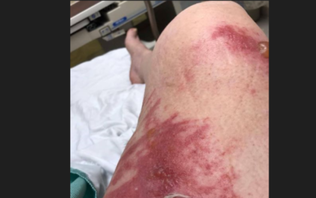 Woman sues Tim Hortons on Hwy 60, says she suffered severe burns due to faulty cup with scalding hot tea