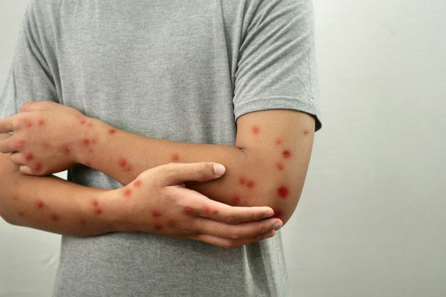 New measles case confirmed in Simcoe Muskoka